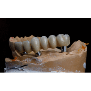 Dental bridge treatment in India